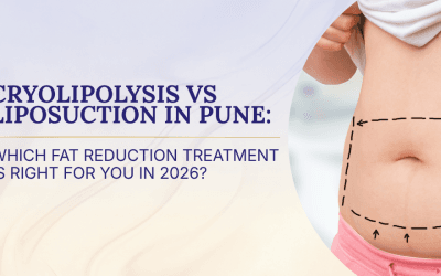 Cryolipolysis vs Liposuction in Pune: Which Fat Reduction Treatment Is Right for You in 2026?