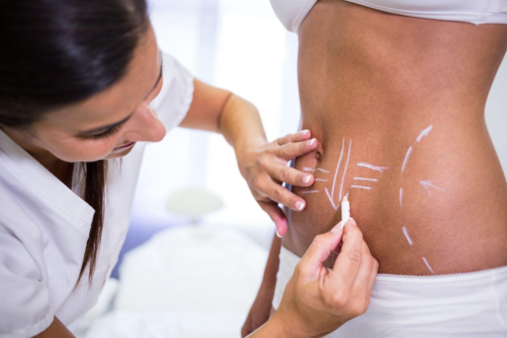 Clinician marks a patient's back with white chalk lines before a procedure, close-up on skin and hands