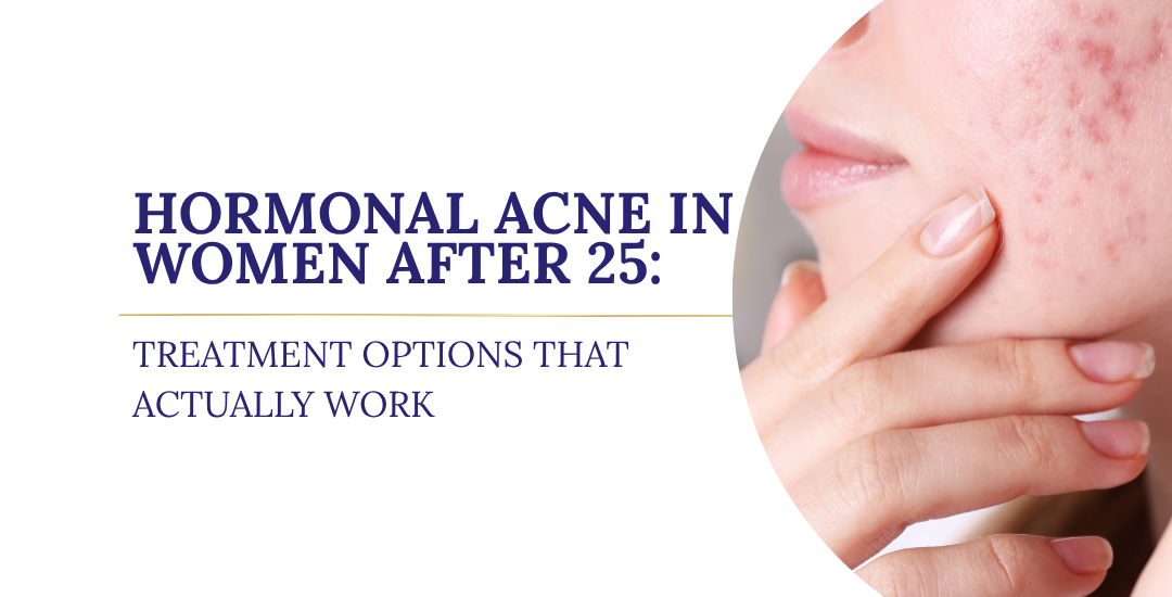 Hormonal Acne in Women