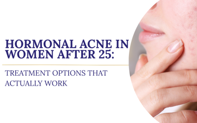 Hormonal Acne in Women After 25: Treatment Options That Actually Work