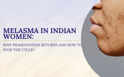 Melasma in Indian Women: Why Pigmentation Returns and How to Stop the Cycle?