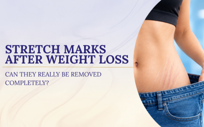 Stretch Marks After Weight Loss: Can They Really Be Removed Completely?